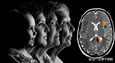 《Nature》干细胞让痴呆患者脑与海马体积萎缩下降48.4%和50%以上-2.jpg